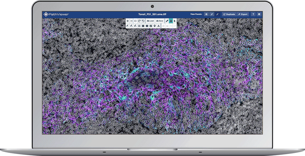 laptop display showing fluorescence image with multiple channels and analytical results overlaid using PathViewer, Glencoe Software’s digital pathology solution