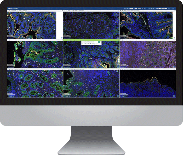 PathViewer with PathViewer GRID, Glencoe Software’s Digital Pathology solution, showing a multi-image workflow
