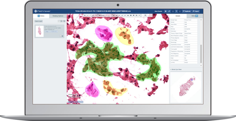 laptop display showing a digital pathology image with regions of interest (ROI) on PathViewer, Glencoe Software’s digital pathology solution