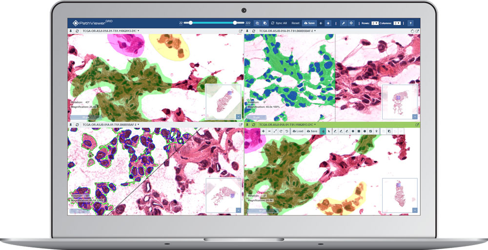 laptop display showing digital pathology images with regions of interest (ROI) on four separate panels via PathViewer GRID, Glencoe Software’s digital pathology solution