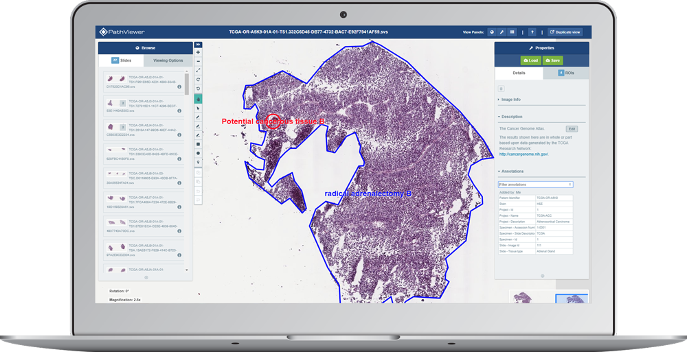 laptop display showing digital pathology image with two regions of interest (ROIs) using PathViewer, Glencoe Software’s digital pathology solution