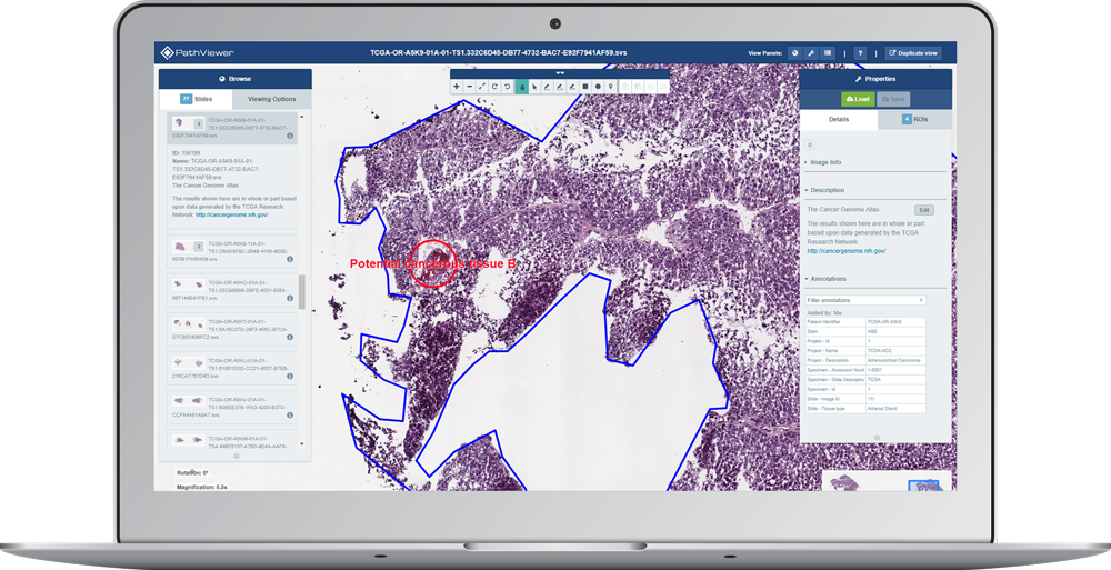 laptop screen showing digital pathology image with two regions of interest (ROIs) displayed on PathViewer