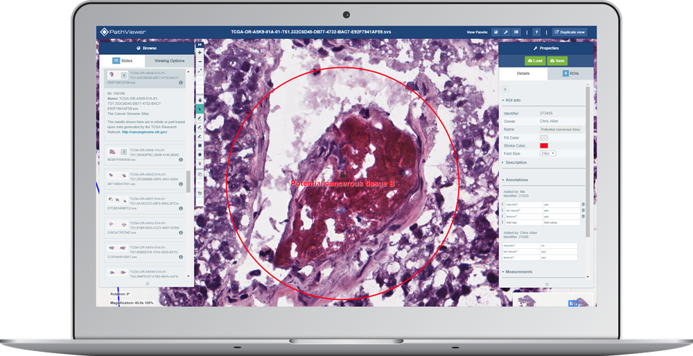 laptop screen showing digital pathology image with region of interest (ROI), displayed on PathViewer